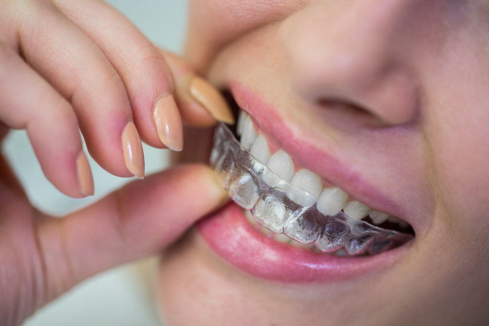 Implantes e reabilitação oral: Solução para um sorriso completo 4 aparelho dentista comum invisivel